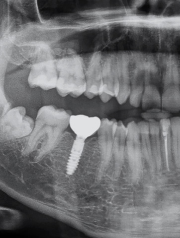 Xray of right set of teeth which includes a dental implant