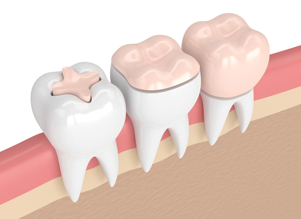 A 3d image of 3 teeth with various caps for restoration