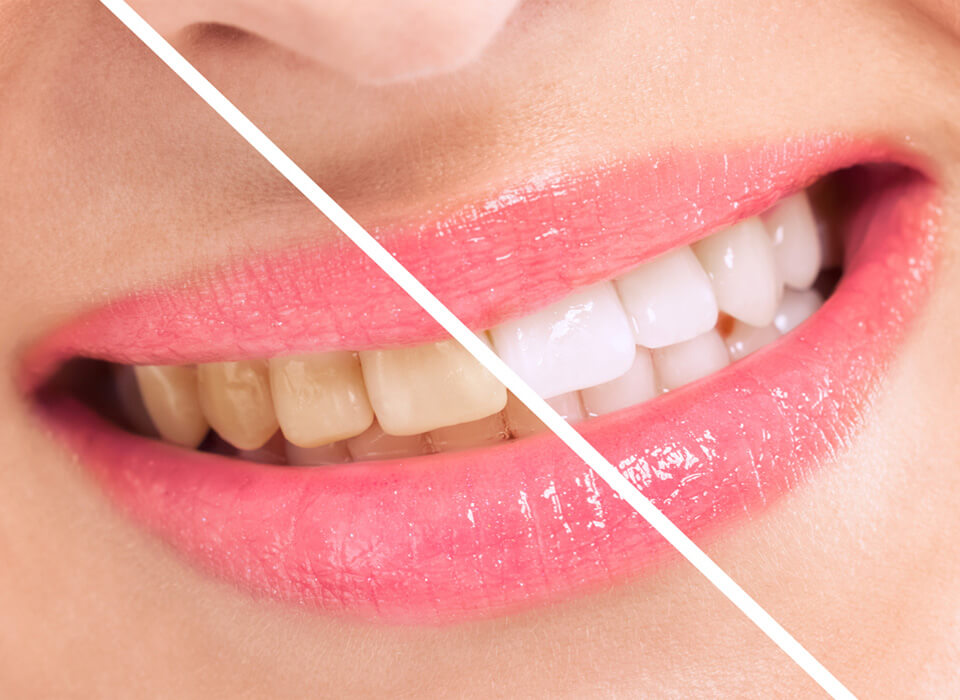A before after tooth whitening image of a woman teeth in a single image